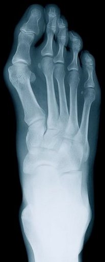 a lábujjak rheumatoid arthritis